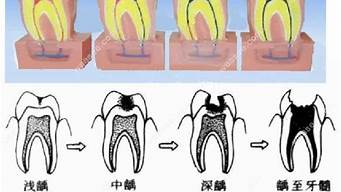 牙齿龋坏不治疗会怎样？牙科医生为你解答(牙齿龋坏不补有影响吗)